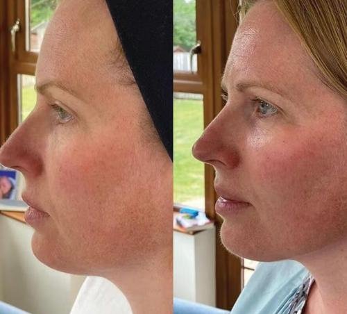 LiftContour Pro YRENNA