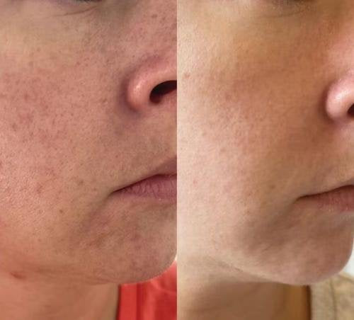 LiftContour Pro YRENNA